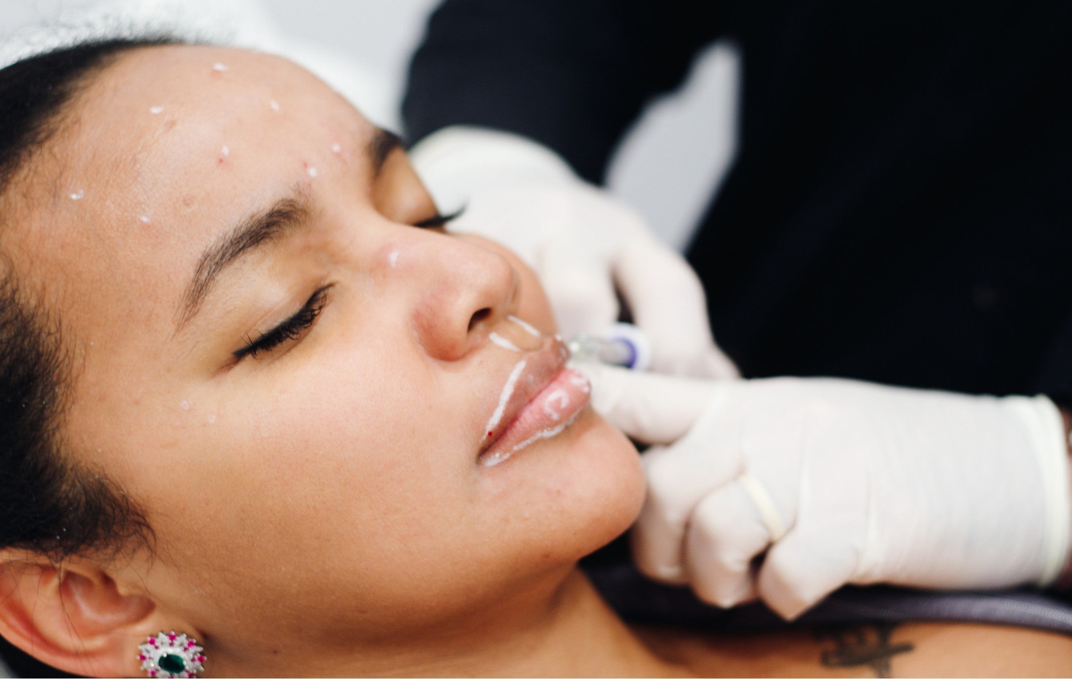5 Myths About Botox and Fillers That Modern Aesthetics Has Outgrown
